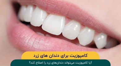 آیا کامپوزیت میتواند دندانهای زرد را اصلاح کند؟